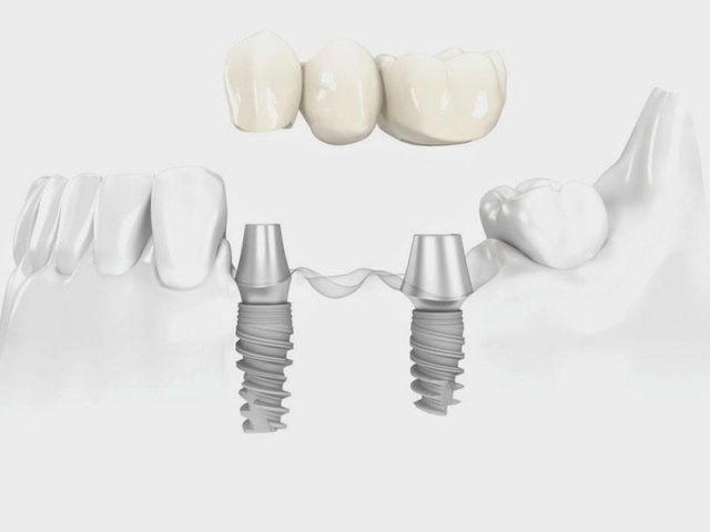 Implant
