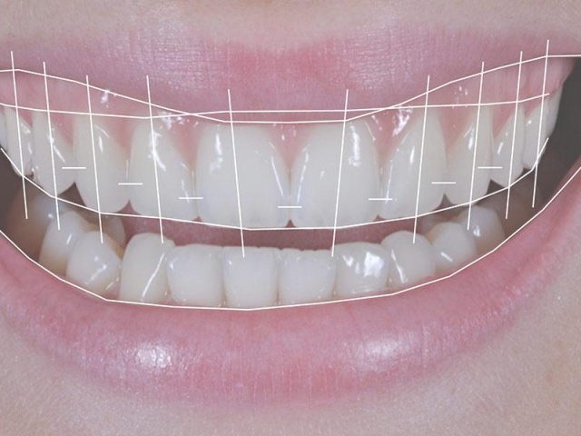 Smile Design