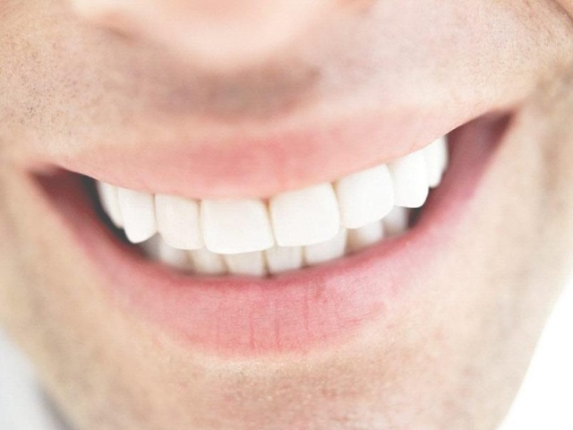Teeth Whitening | Bleaching